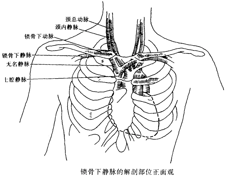 锁骨下静脉穿刺置管术修改后_第3页