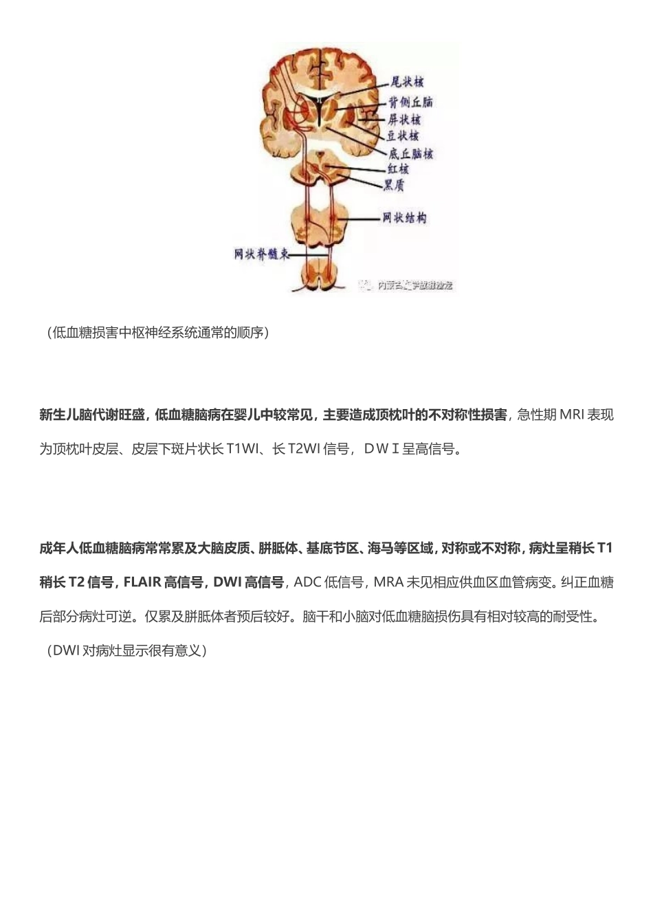 低血糖脑病的MRI表现及鉴别_第2页