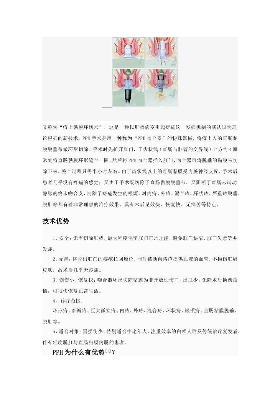 PPH环切术_第2页
