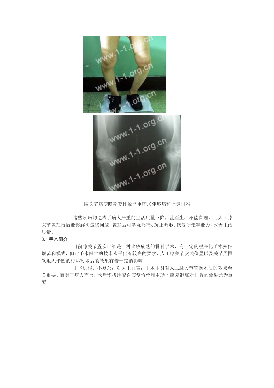 人工膝关节置换术后康复指南_第3页
