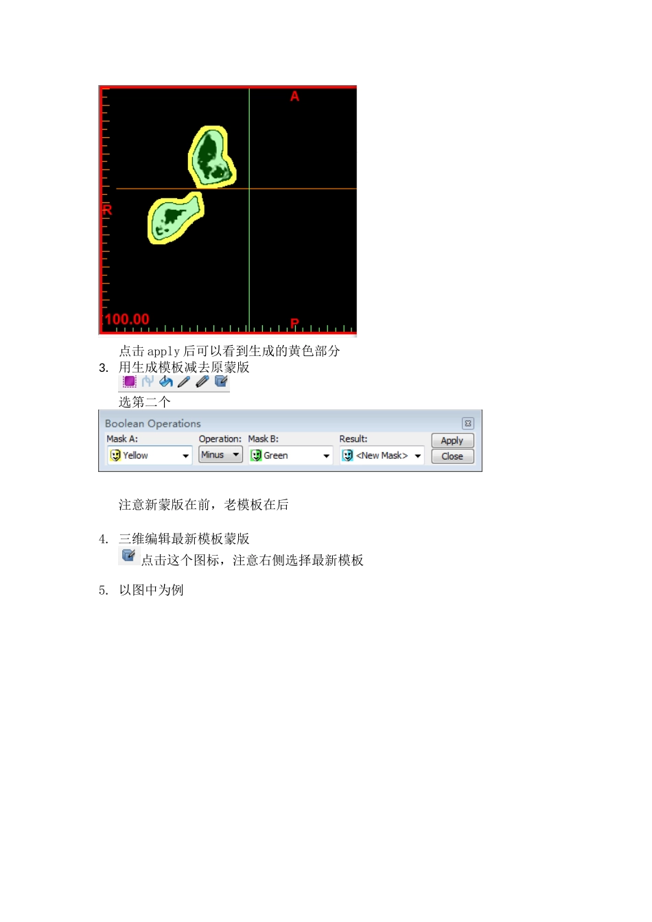 mimics手术导板制作-简单易行_第2页