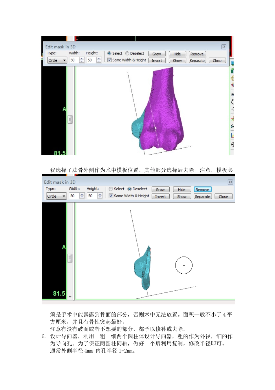 mimics手术导板制作-简单易行_第3页