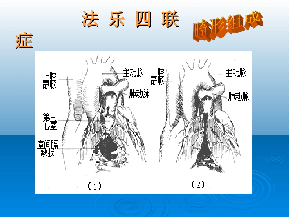 法洛四联症._第3页