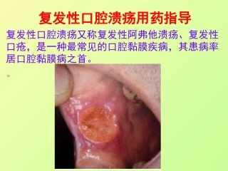 复发性口腔溃疡用药指导