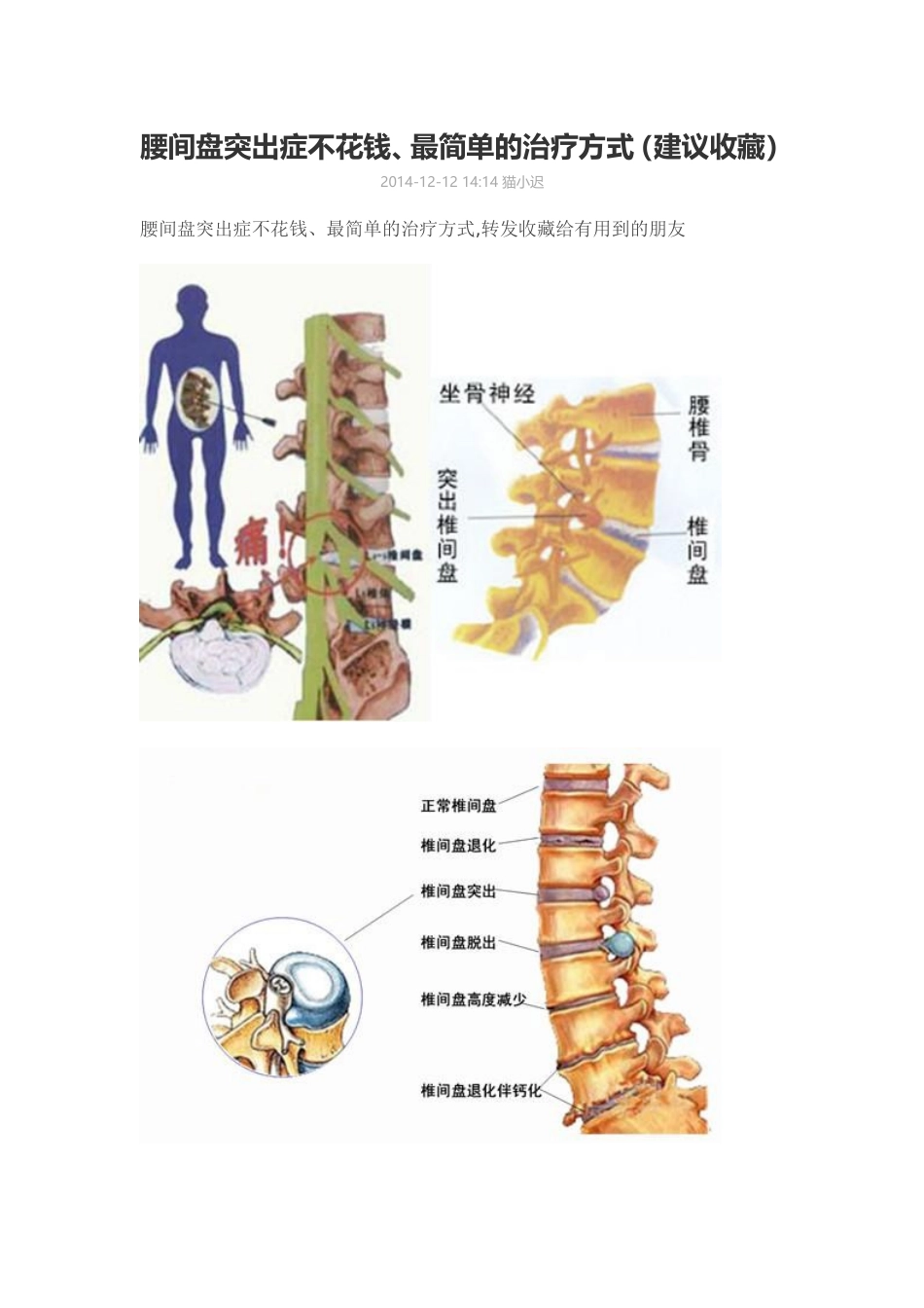 腰间盘突出症不花钱_第1页