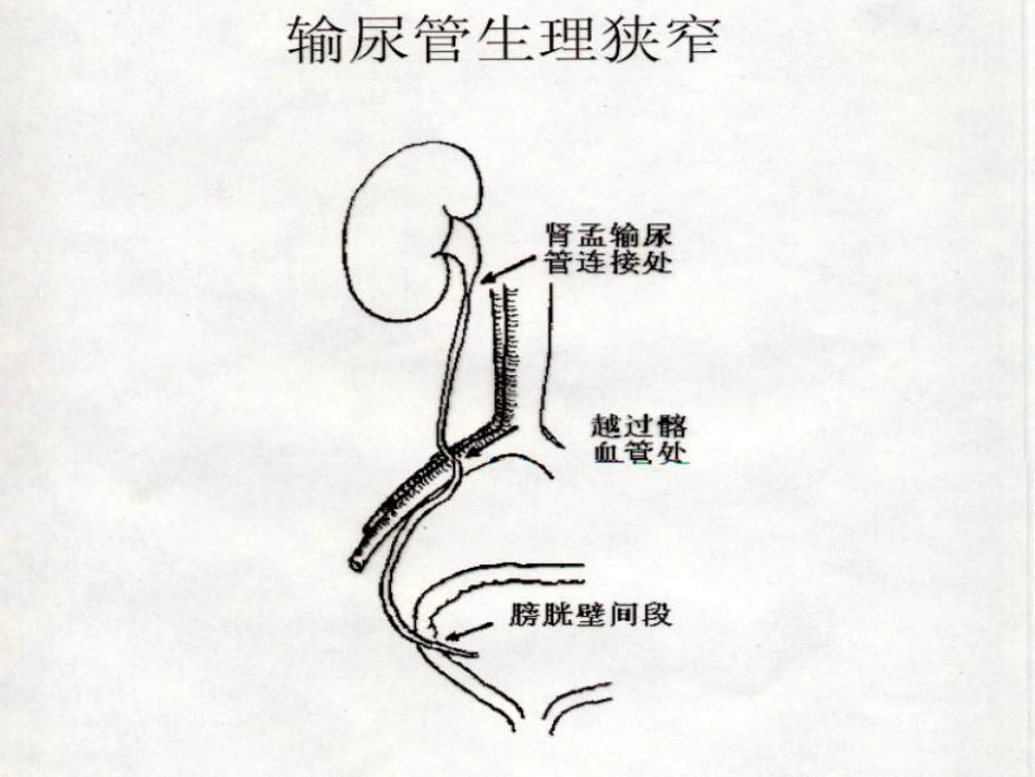 输尿管梗阻病人_第3页