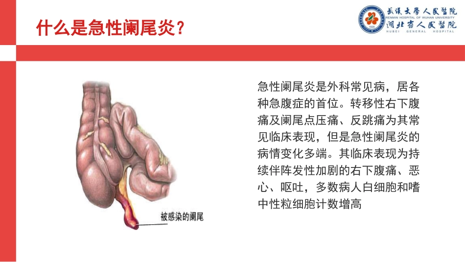 急性阑尾炎查房_第3页