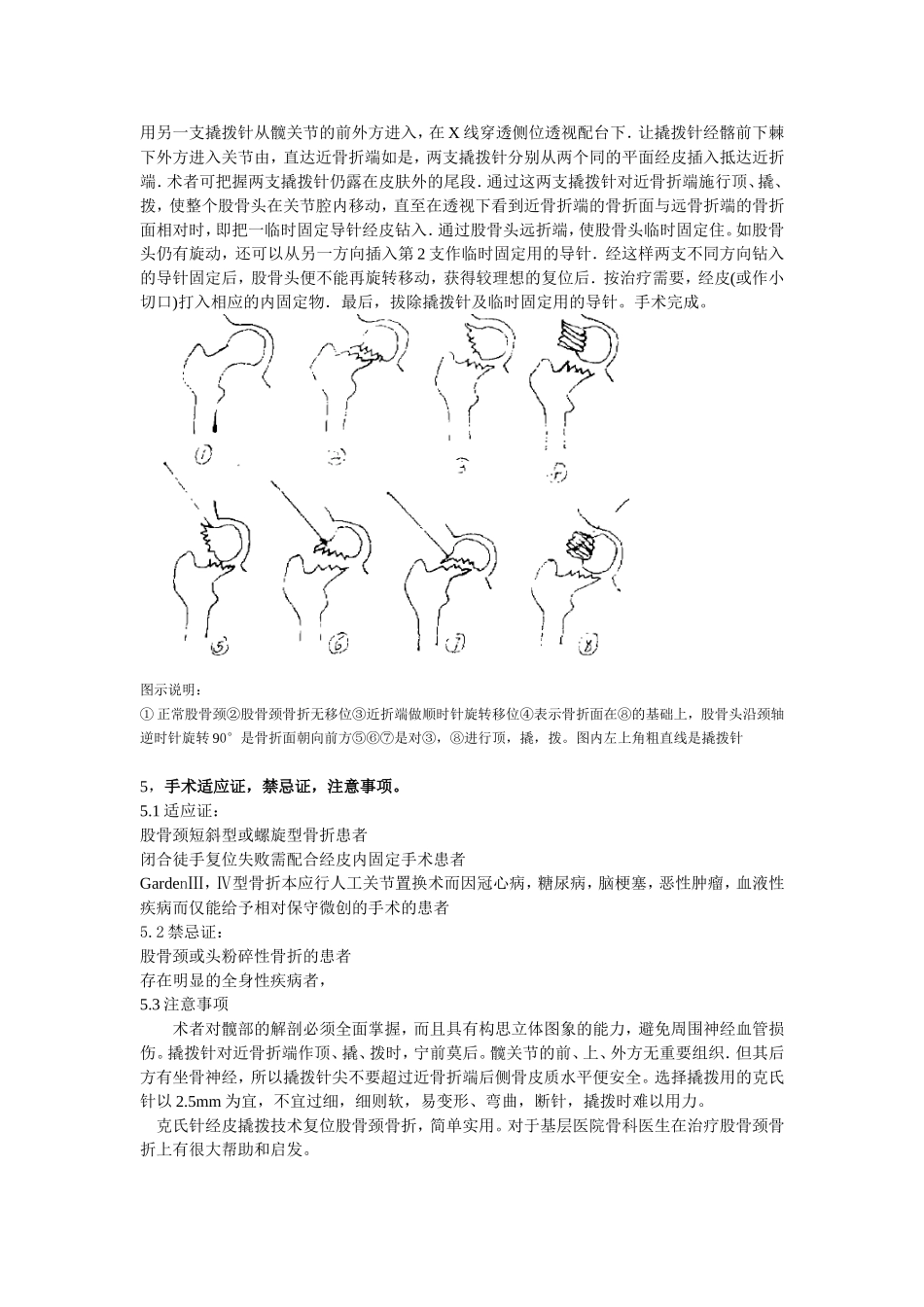 克氏针撬拨技术在闭合复位股骨颈骨折中的运用_第2页