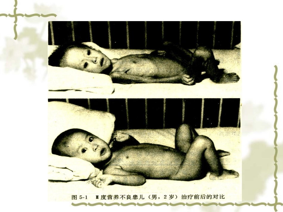 儿科营养-营养不良症_第3页