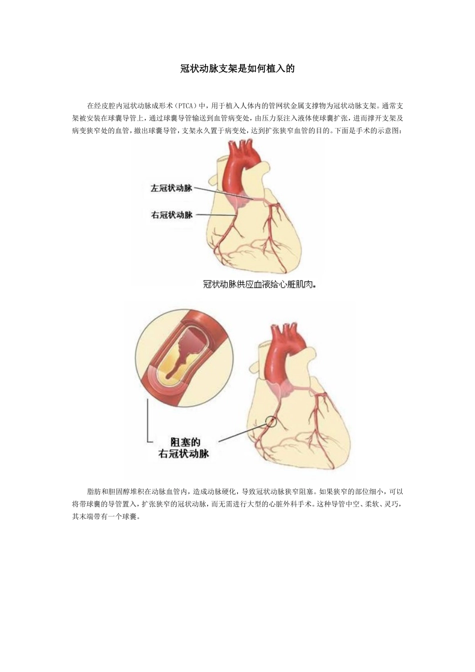 冠状动脉支架是如何植入的_第1页
