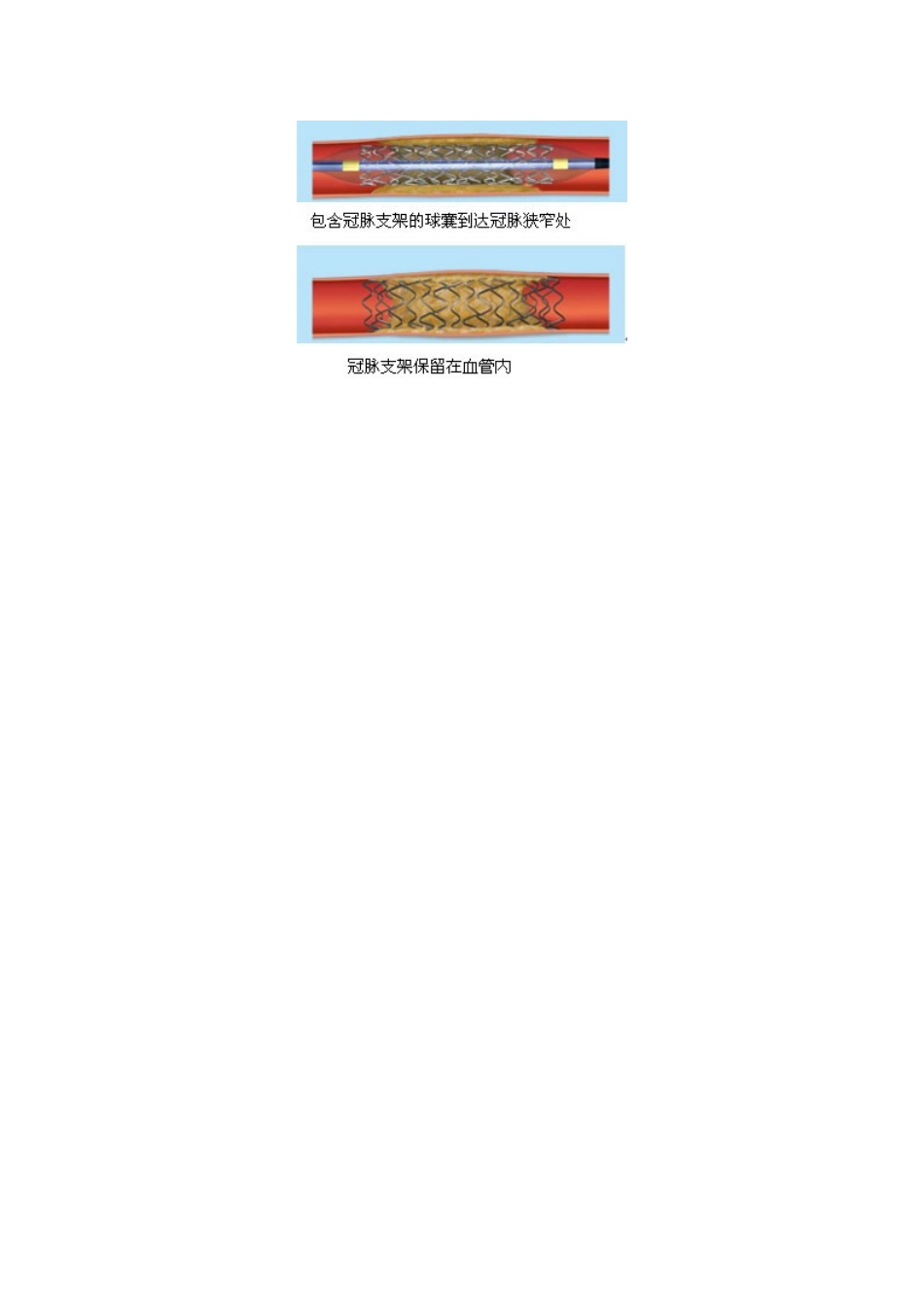 冠状动脉支架是如何植入的_第3页