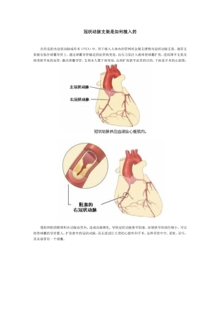 冠状动脉支架是如何植入的