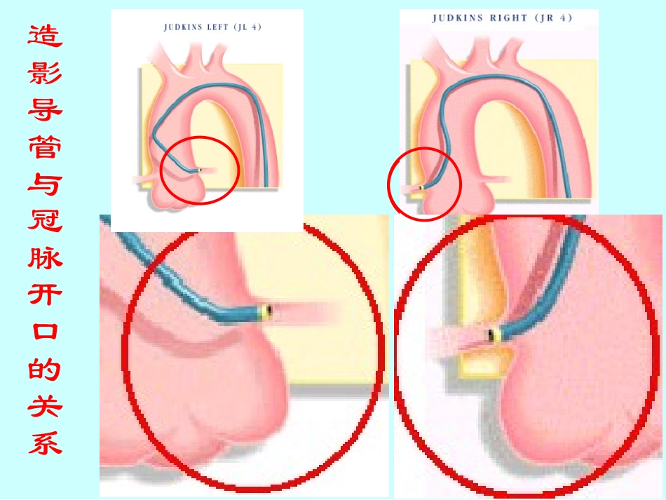 冠状动脉开口处病变1(精)_第3页