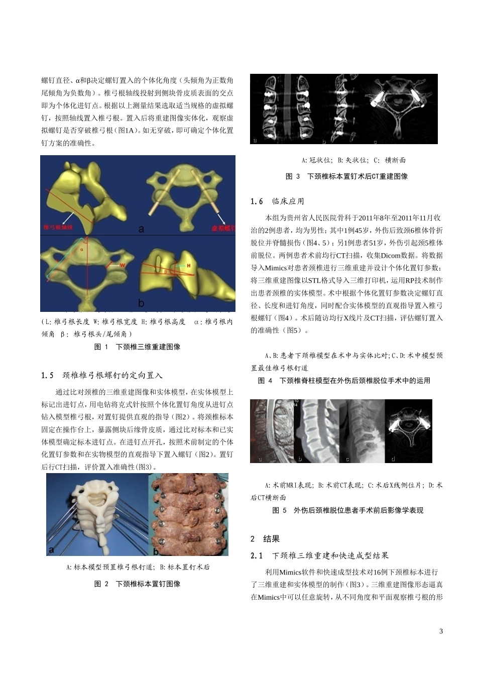 Mimics及脊柱模型用于下颈椎椎弓根个体化置钉的应用研究_第3页