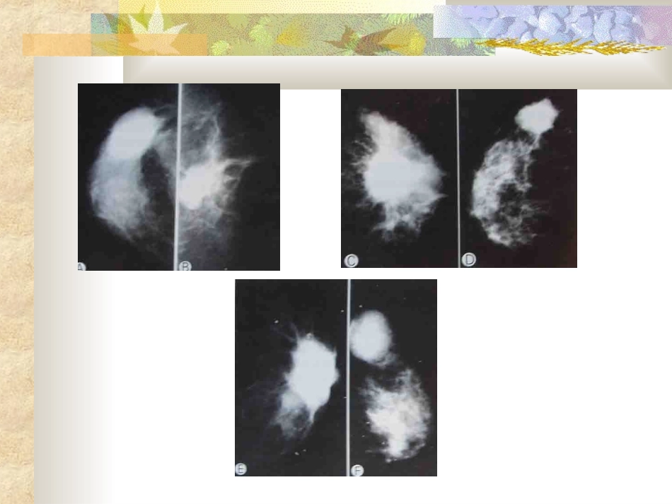 乳腺癌的X线影像学表现_第3页