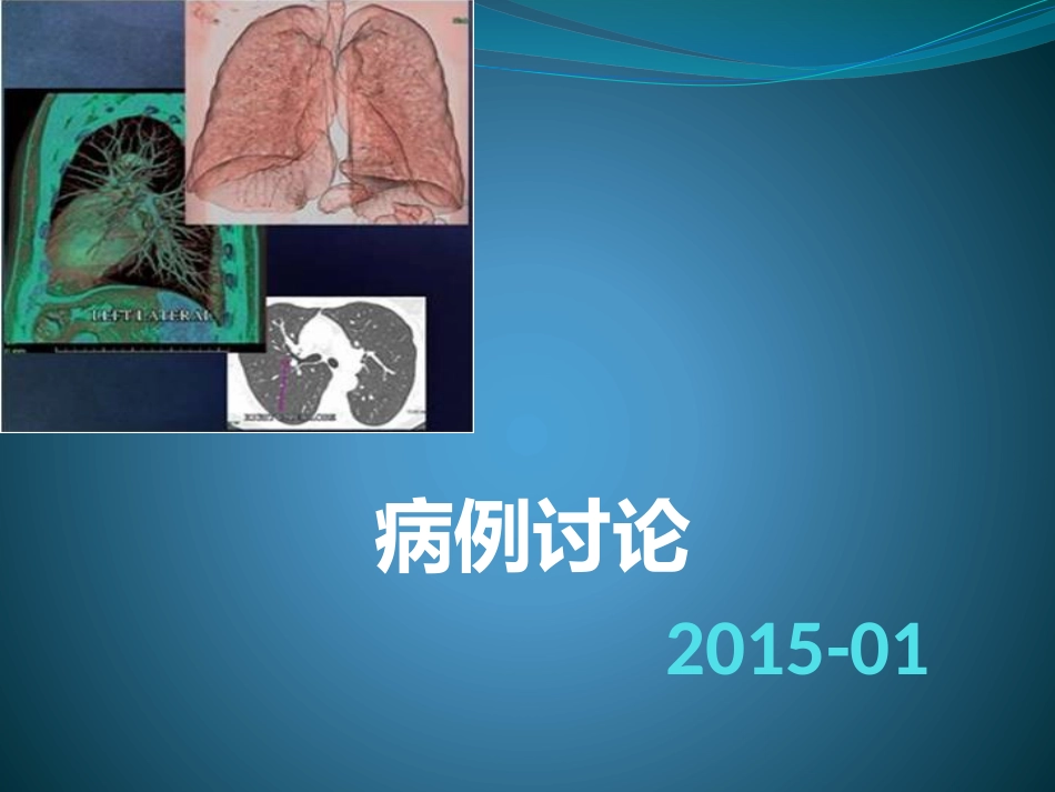 孤立性肺结节_第1页