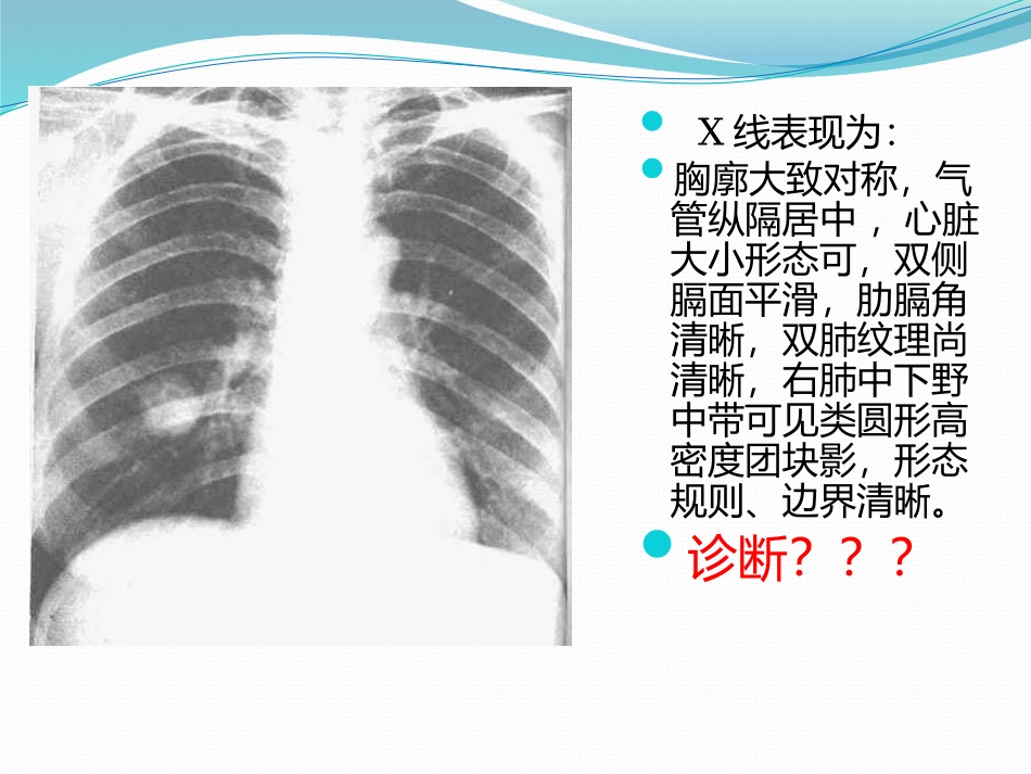 孤立性肺结节_第2页