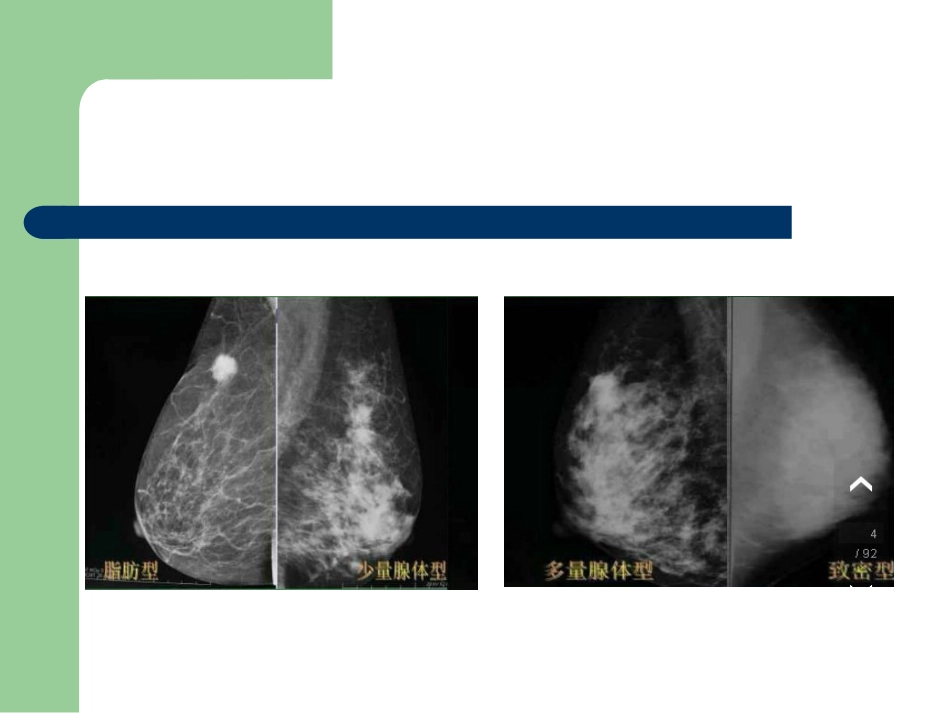 乳腺BIRADS分级_第3页