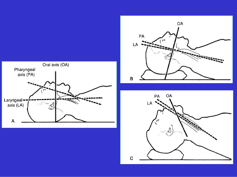 气管插管及困难气道_第2页