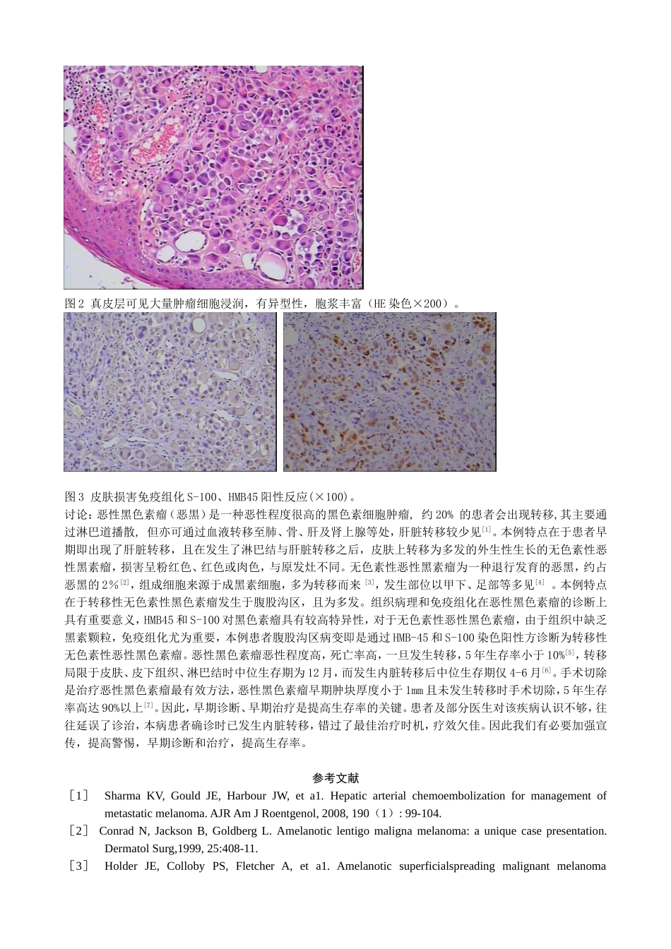 恶性黑色素瘤多发转移1例_第2页