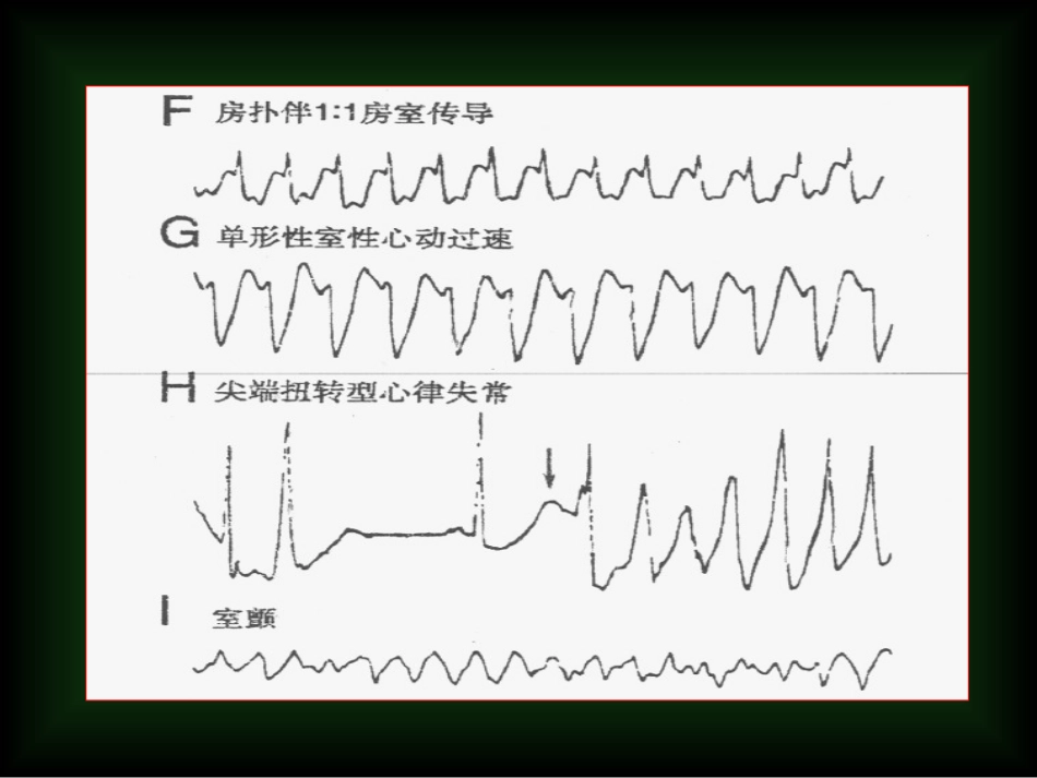 抗心律失常药2010-PPT文档_第3页
