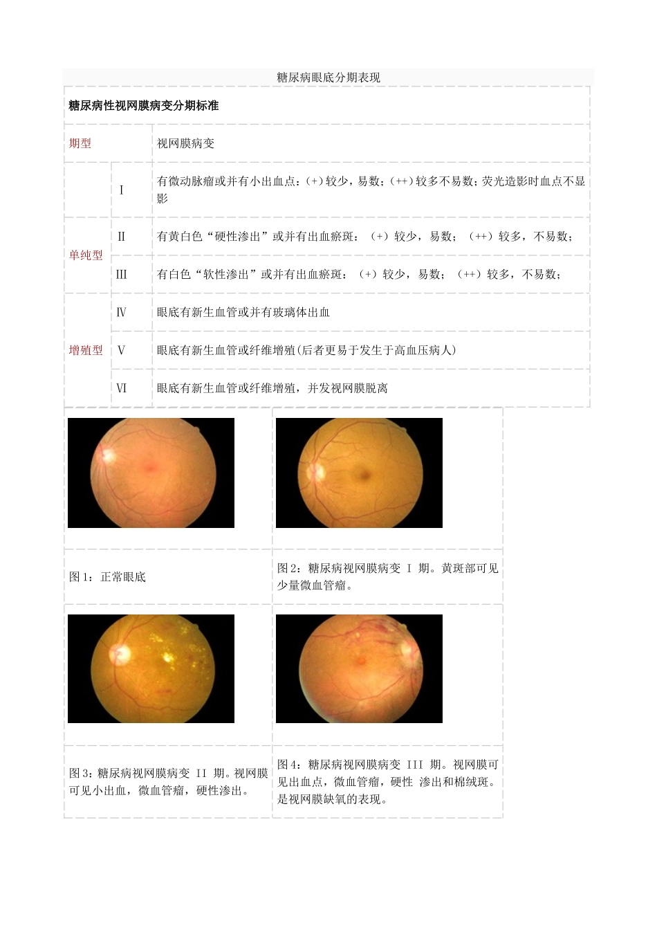 糖尿病眼底分期表现_第1页