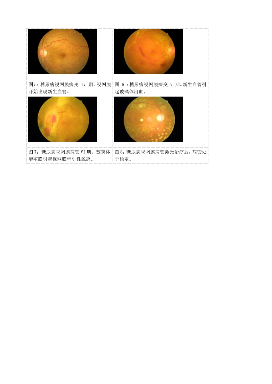 糖尿病眼底分期表现_第2页