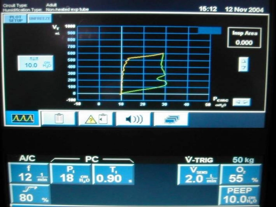 呼吸机基本波形详解_第2页
