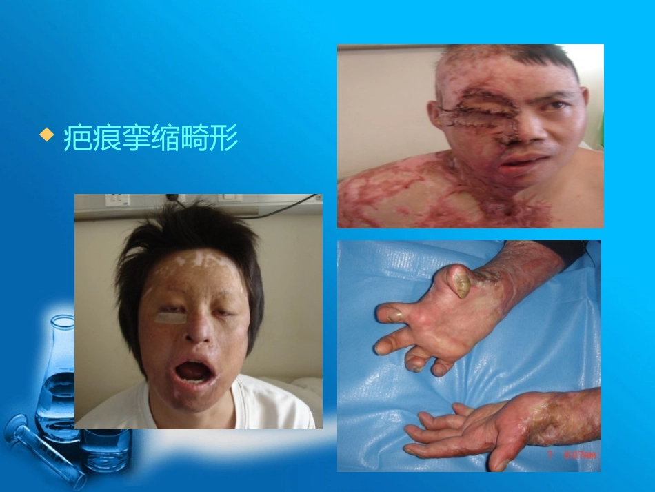 烧伤疤痕康复训练_第2页