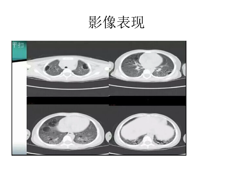 朗格罕斯细胞组织细胞增生症.._第3页