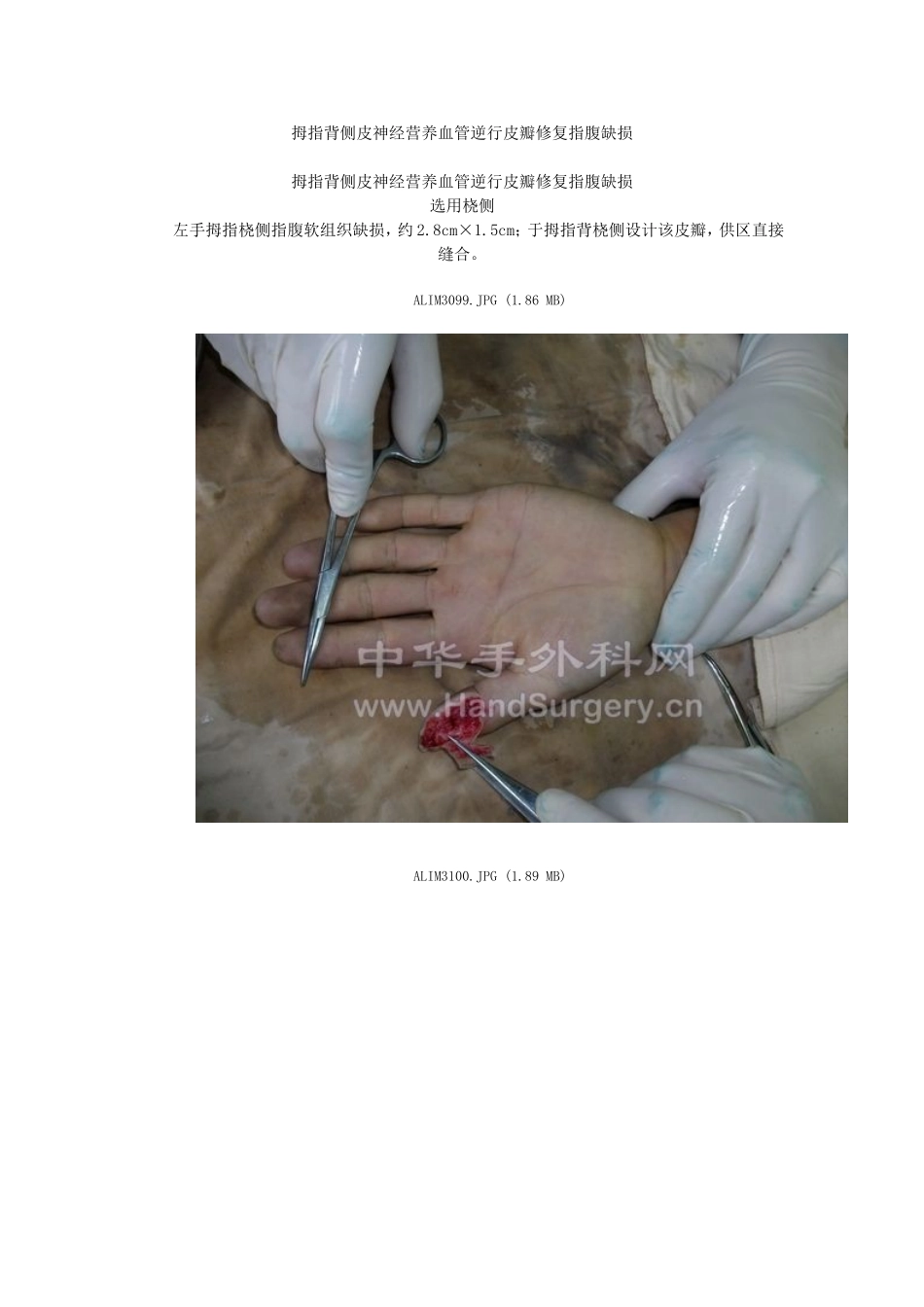 拇指背侧皮神经营养血管逆行皮瓣修复指腹缺损_第1页