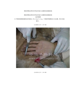 拇指背侧皮神经营养血管逆行皮瓣修复指腹缺损