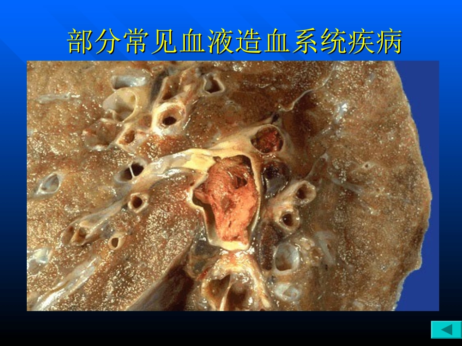 常-见-血-液-造-血-系-统-疾-病_第3页