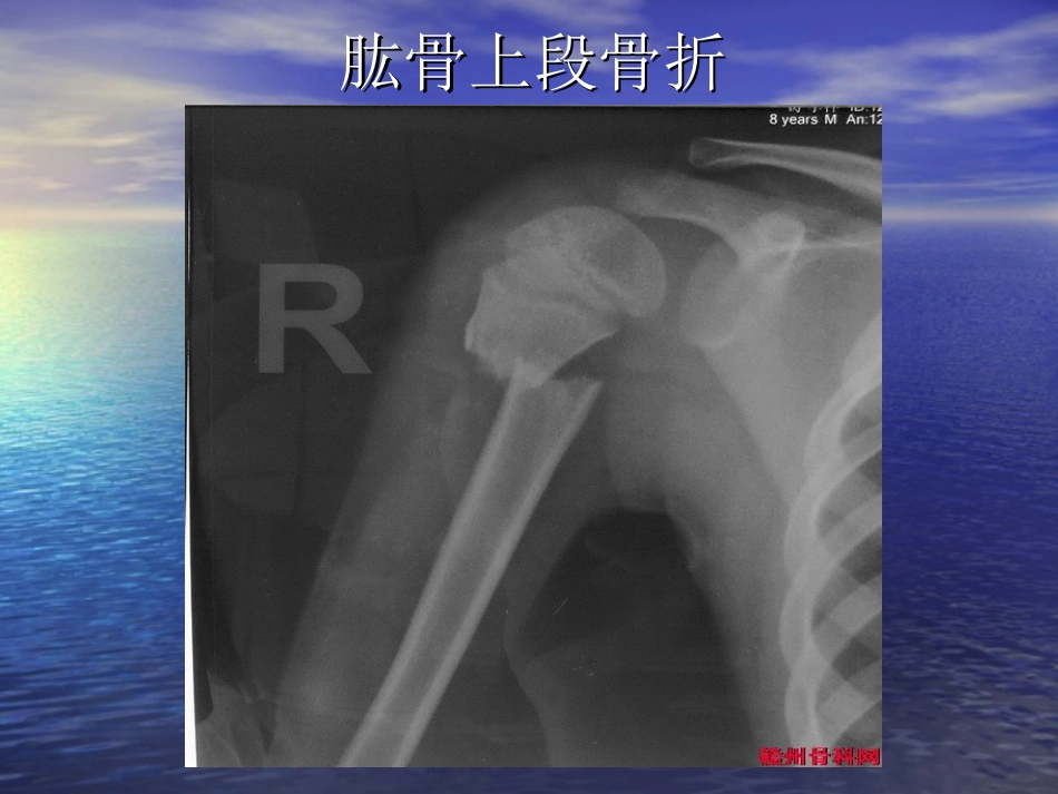 上肢骨折术后康复锻炼_第3页