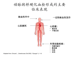 急性冠脉综合症的