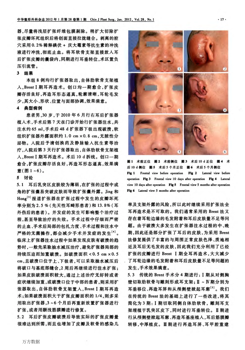 扩张法全耳再造皮瓣破溃后的处理_第2页