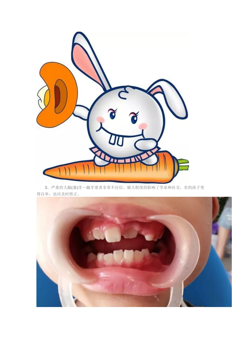 家长注意：必须在12岁前处理的10种儿童牙颌畸形!_第3页