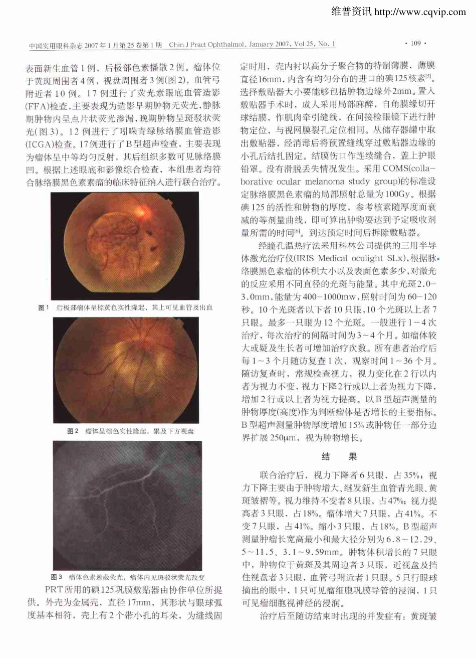 经瞳孔温热疗法联合敷贴放疗治疗脉络膜黑色素瘤的临床观察-http_第2页