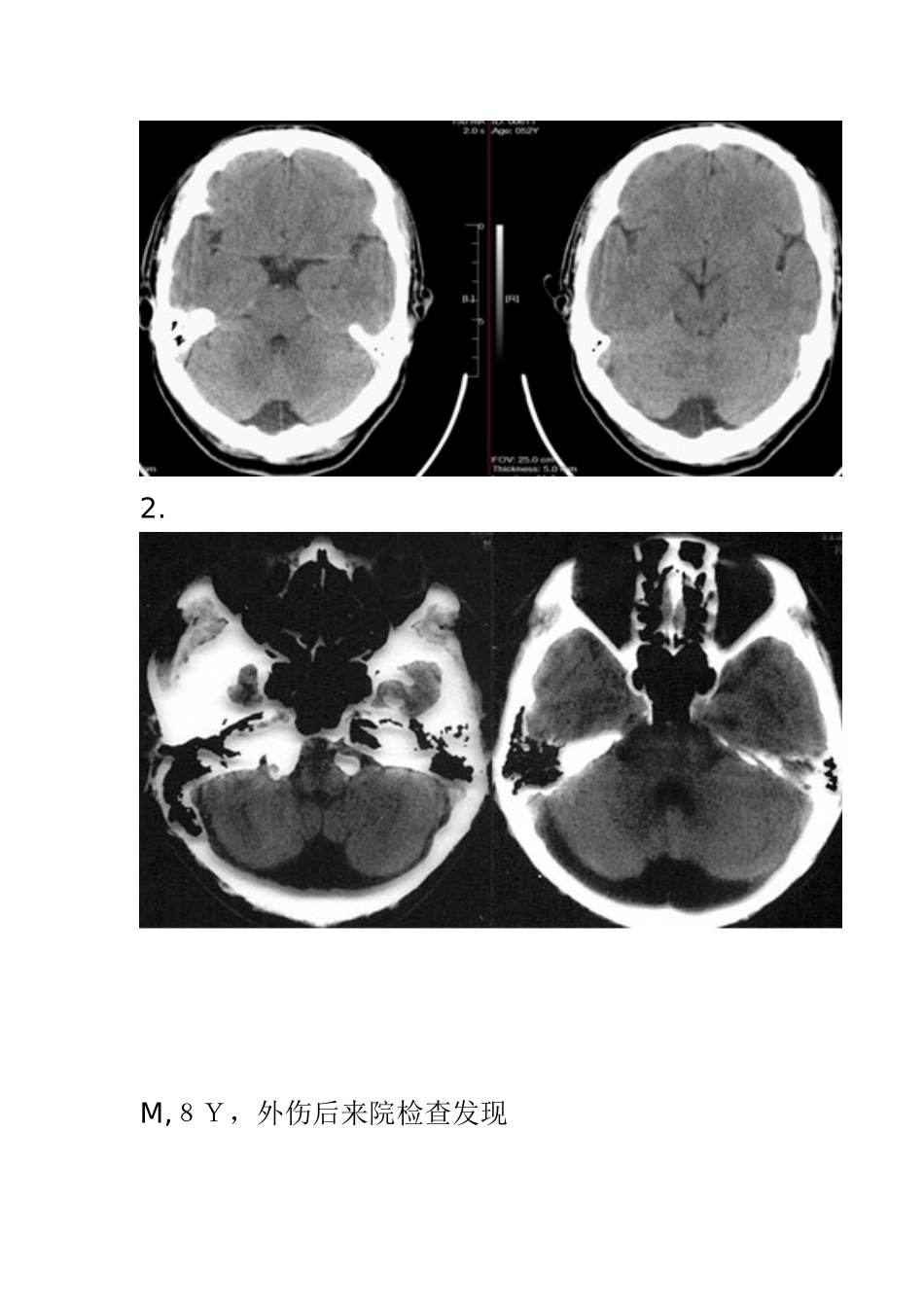 畸形：后颅窝囊性病变的鉴别_第3页
