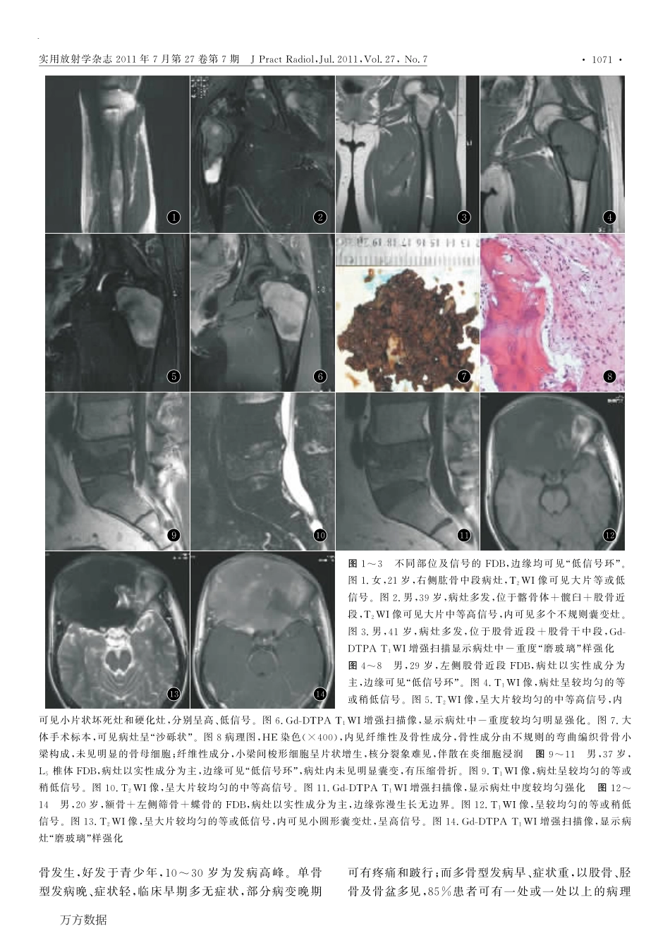 骨纤维结构不良的MRI表现_第3页