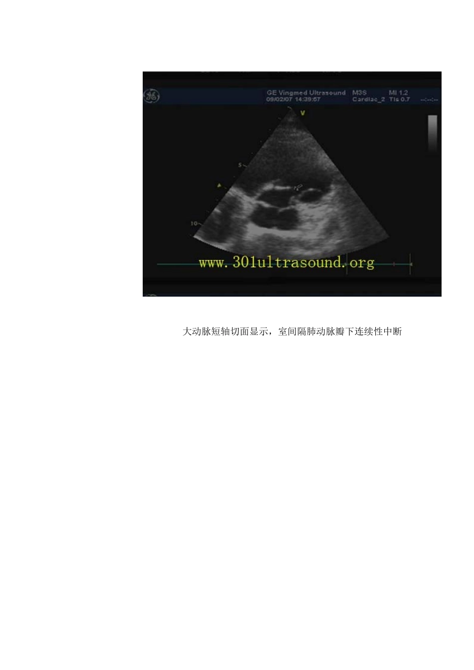 干下型室间隔缺损_第3页