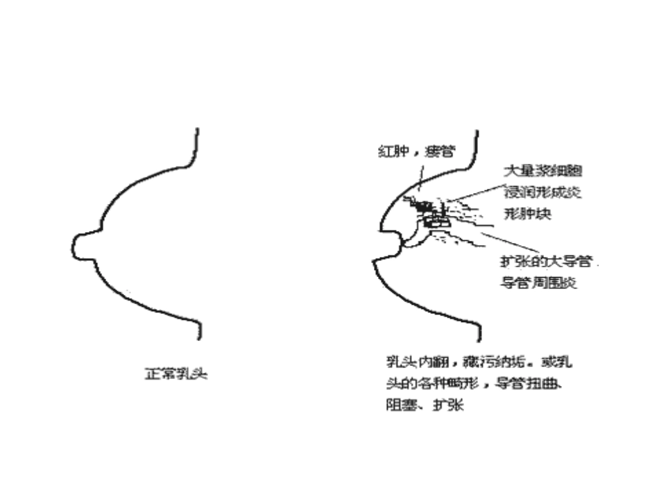 浆细胞性乳腺炎_第2页
