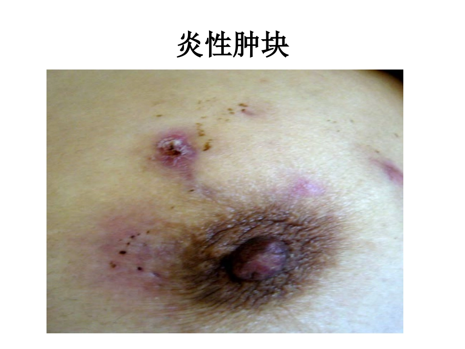 浆细胞性乳腺炎_第3页