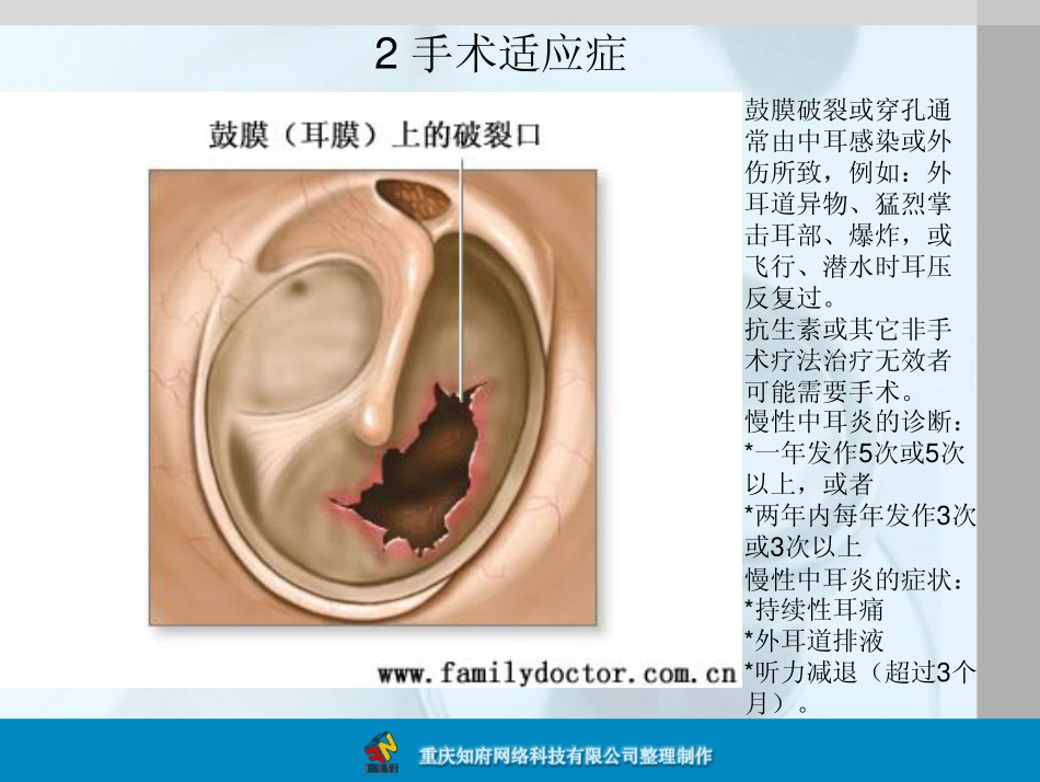鼓膜修复术图解_第3页