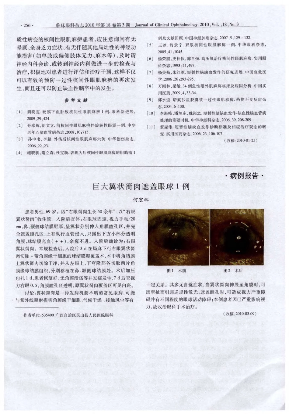急性一过性核间性眼肌麻痹临床分析_第3页