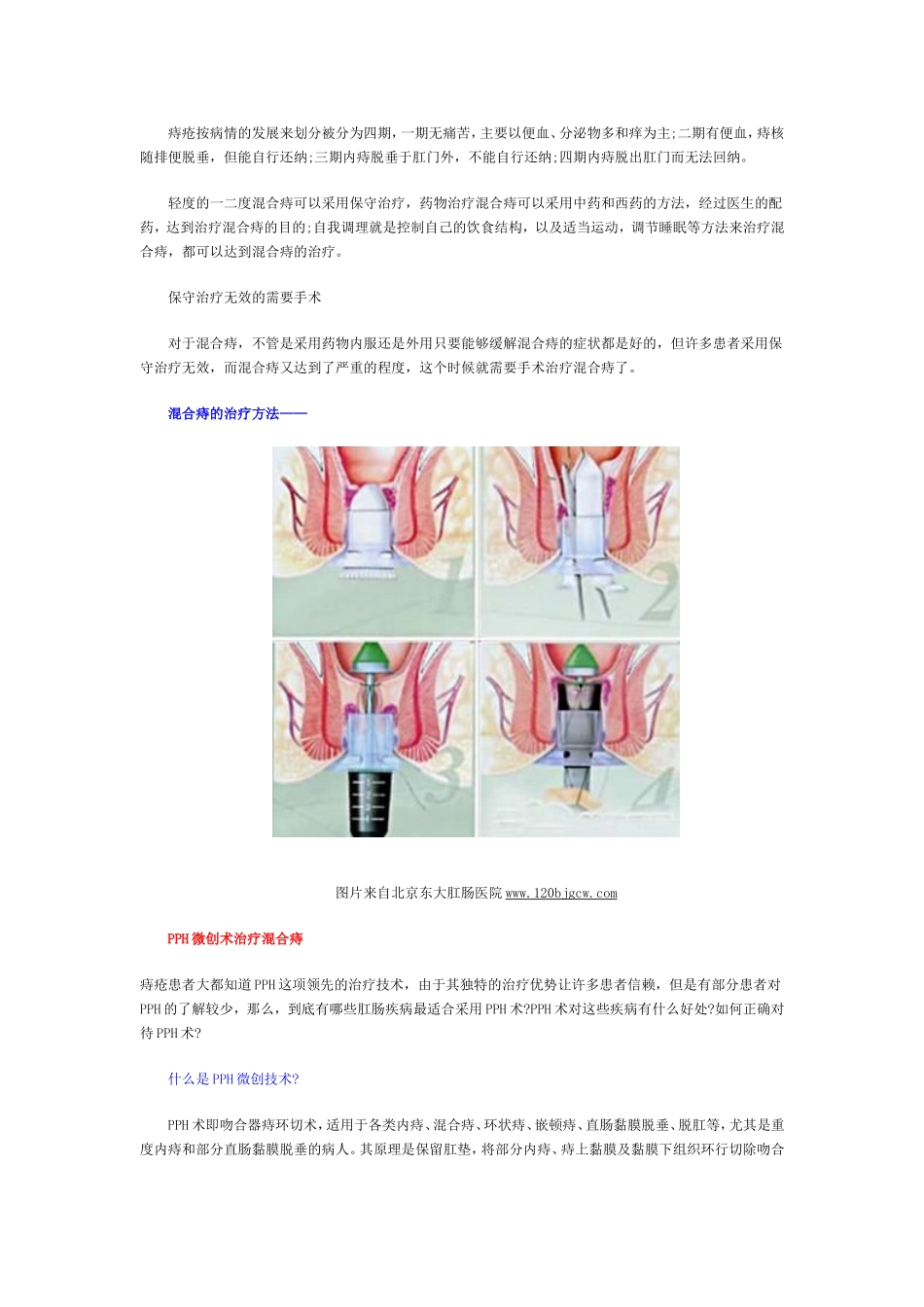 混合痔一定要手术吗_第3页