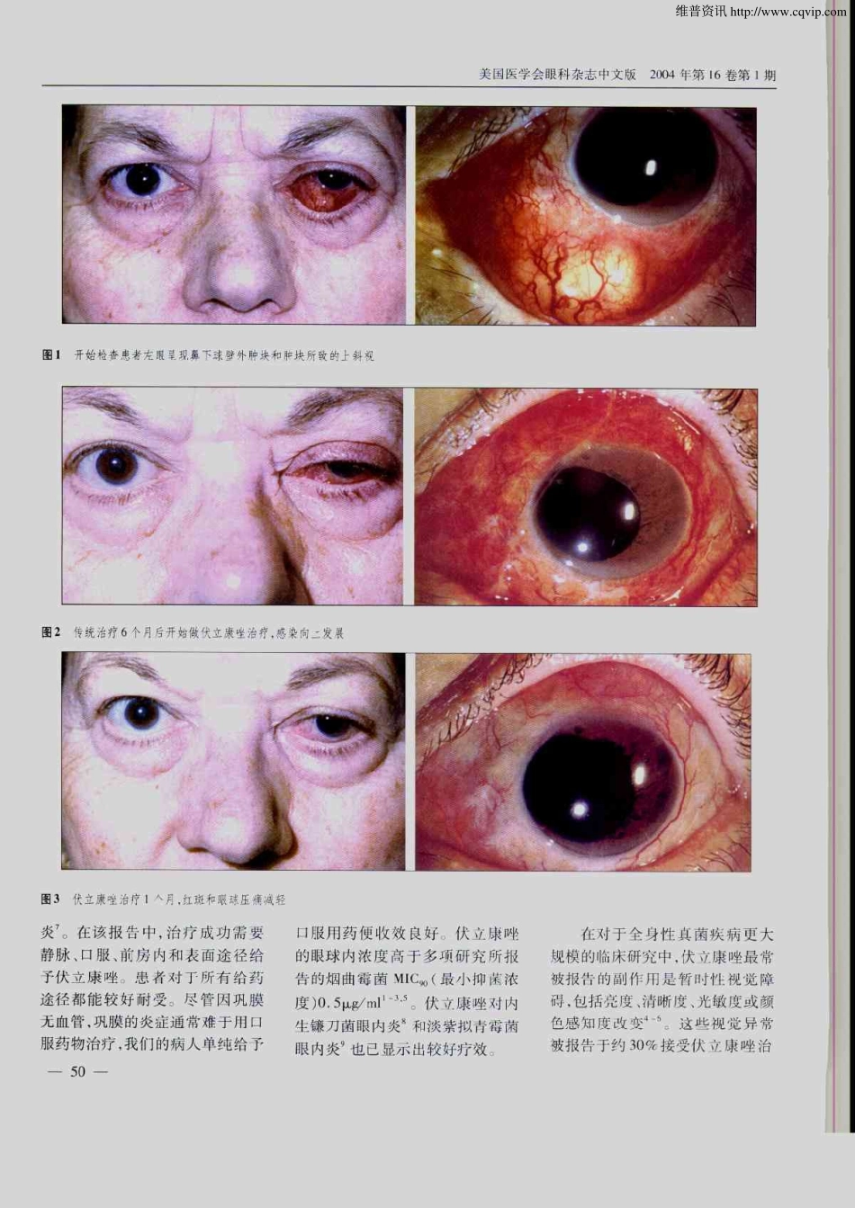 伏立康唑治疗巩膜扣带感染导致的真菌性巩膜炎及球壁外脓肿_第2页