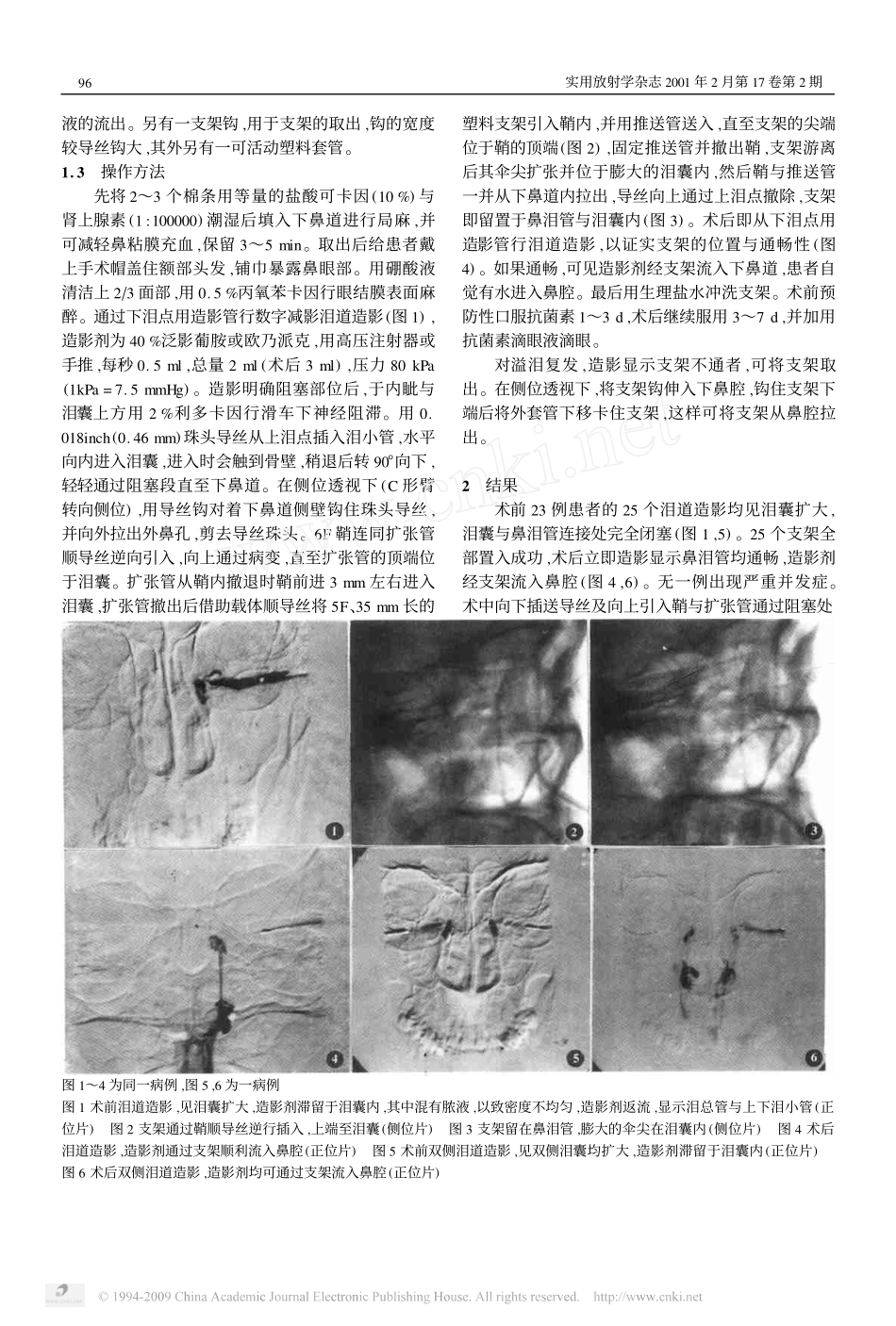 介入性塑料支架置入术治疗鼻泪管阻塞_第2页