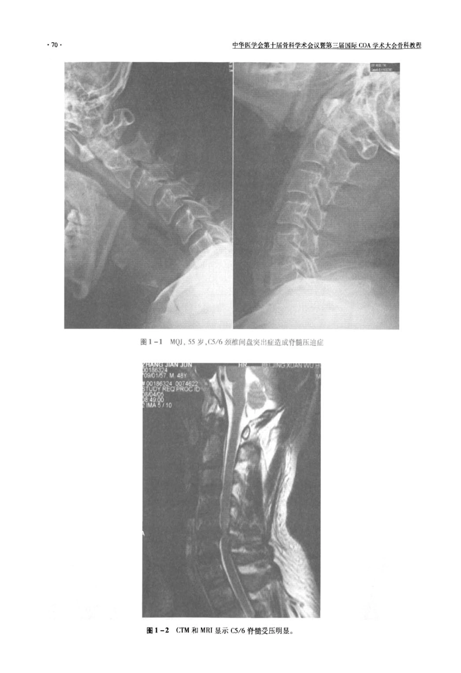 颈椎人工间盘置换手术_第3页