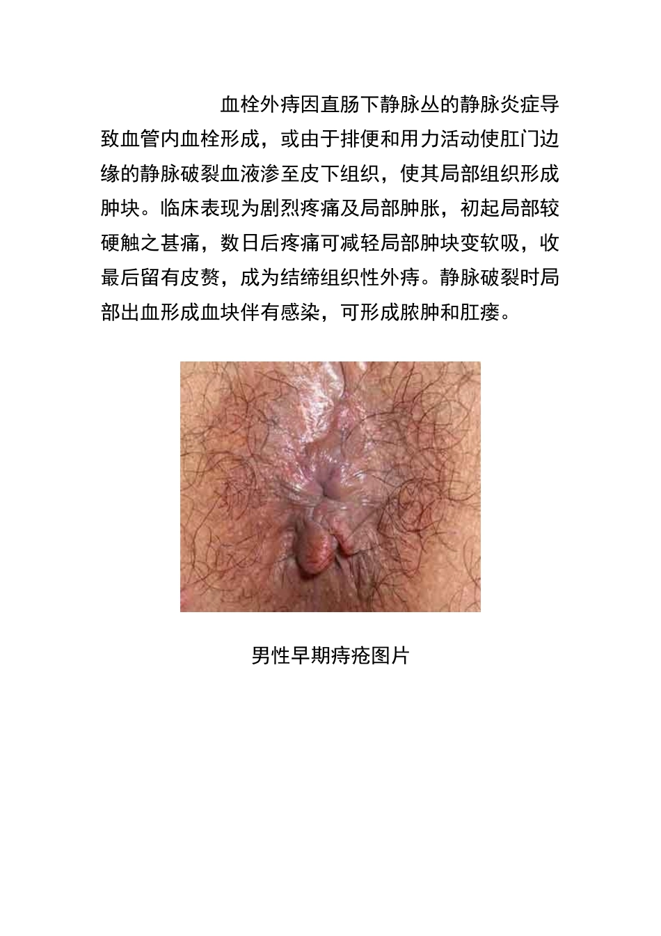 根治痔疮秘方_第3页